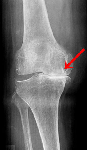 全人工膝関節置換術 手術前