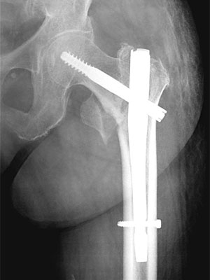 股関節頚部外側骨折（γ-ネイル）